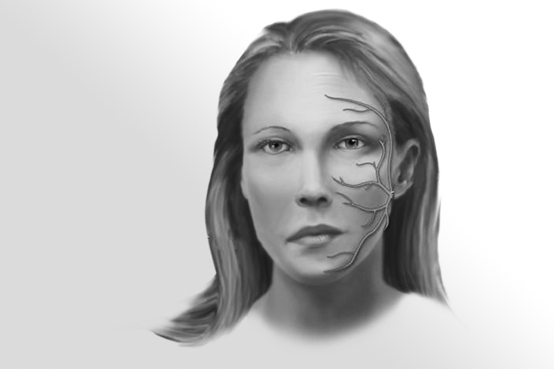 Cirugía de la parálisis facial